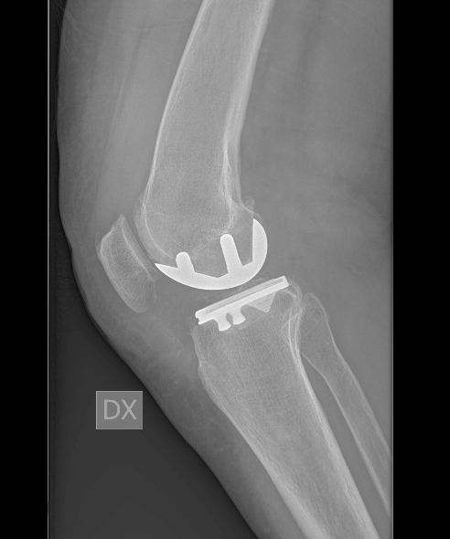 RADIOGRAFIA POSTOPERATORIA 2 (1)